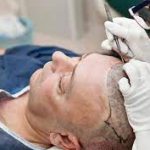 Hair Transplants Can Make You Feel More Confident