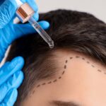 Is Turkey Good For Hair Transplant