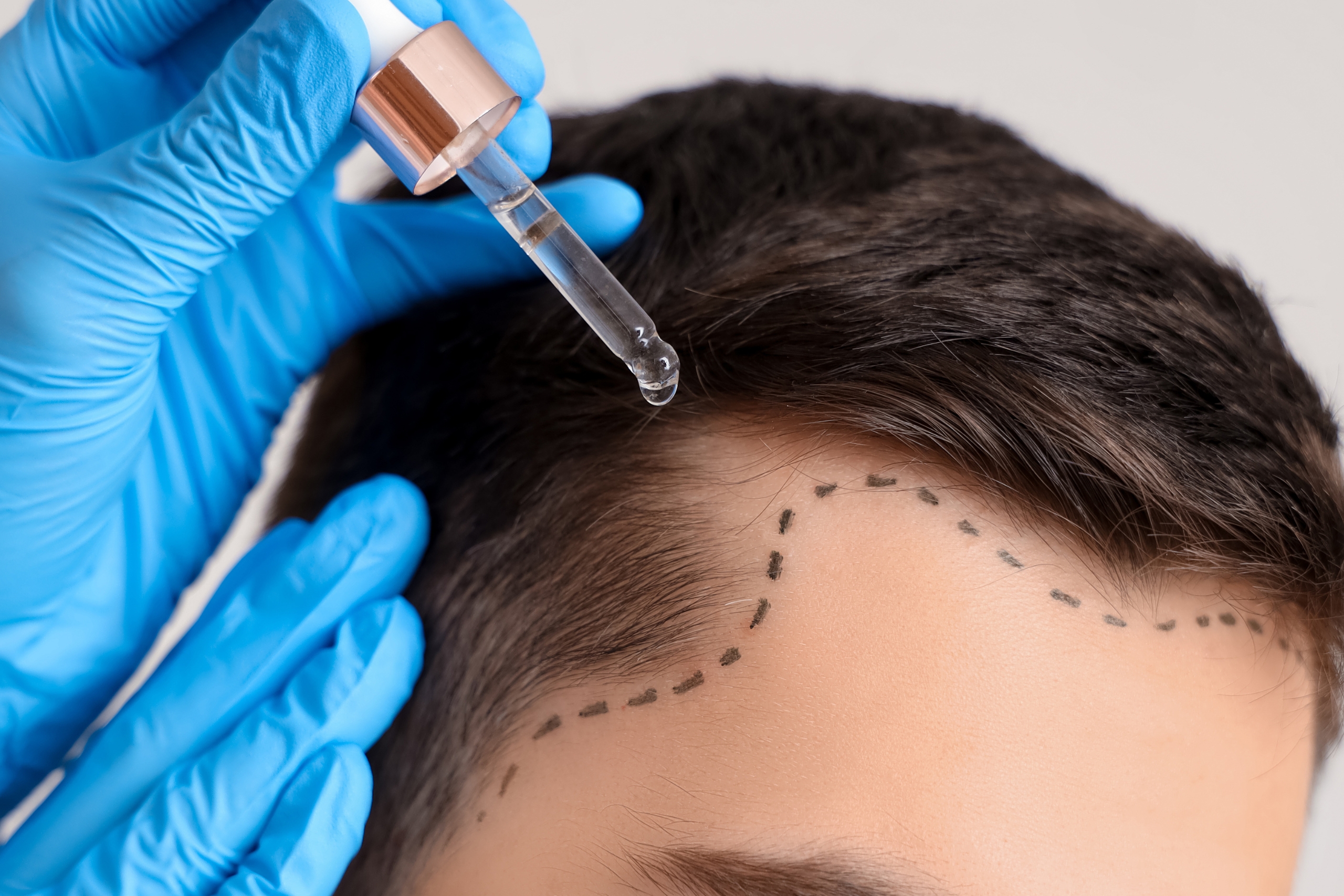 Is Turkey Good For Hair Transplant