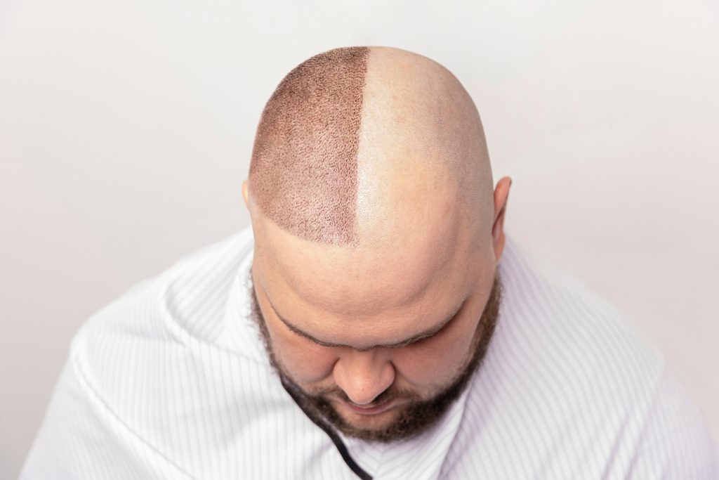 cost of hair transplant turkey